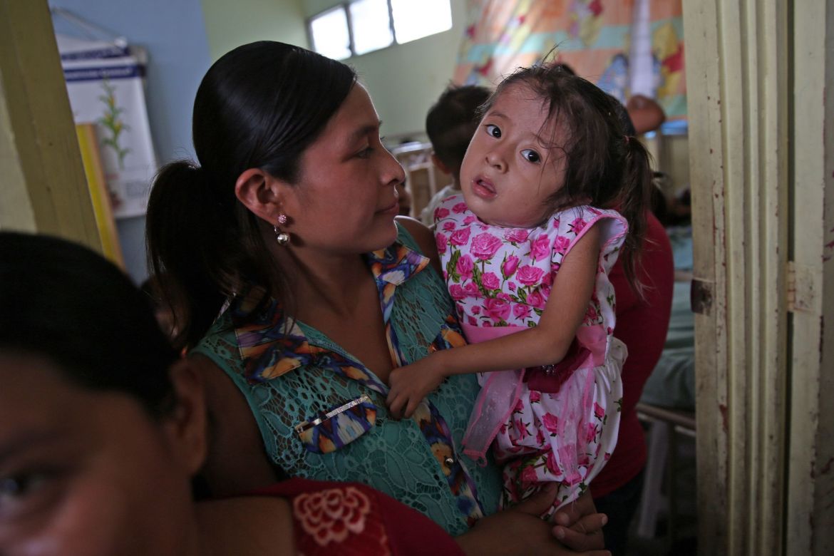 stark unterernährtes Kind in Guatemala